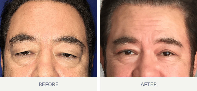 Blepharoplasty before and after in San Antonio, TX