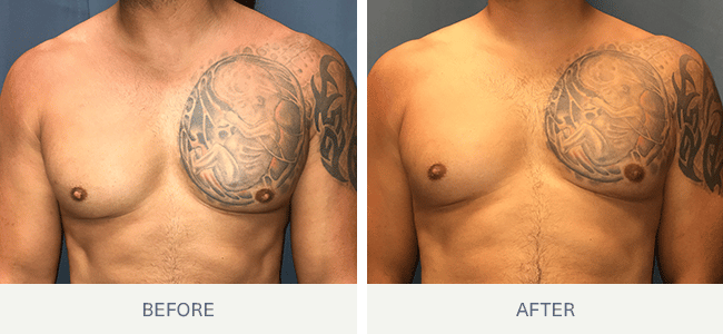 Areola Reshaping Surgery, Nipple Reduction Surgery, Nipple