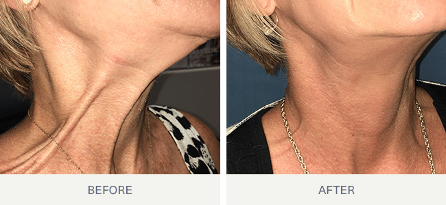 Liposuction for Men Before & After Photos Patient 149