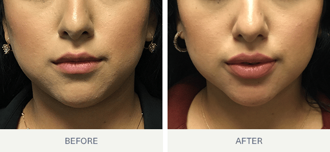 Lip Fillers Before & After Photos San Antonio,