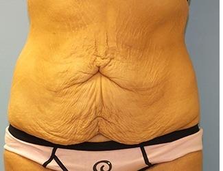Tummy Tuck Before & After Patient #8197