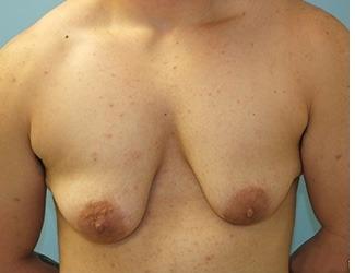 Female to Male Before & After Patient #8444