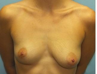 Breast Augmentation Before & After Patient #8246
