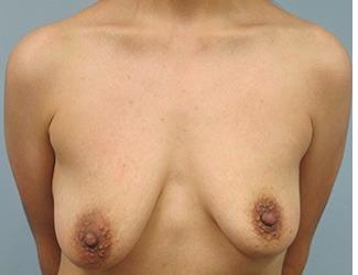 Breast Lift/Mastopexy Before & After Patient #8371
