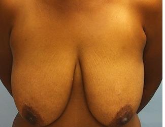 Breast Reduction Before & After Patient #8419
