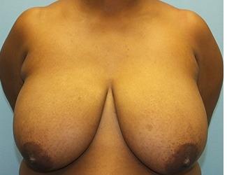 Breast Reduction Before & After Patient #8415