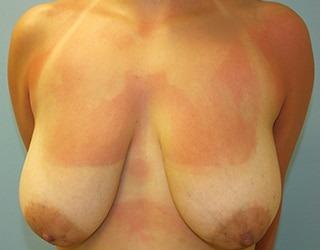 Breast Reduction Before & After Patient #8418