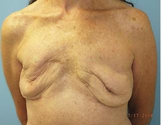 Breast Revision Before & After Patient #8240