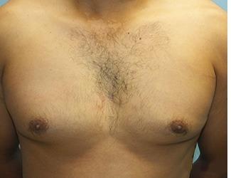 Gynecomastia Before & After Patient #8441