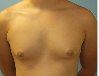Gynecomastia Before & After Patient #8439
