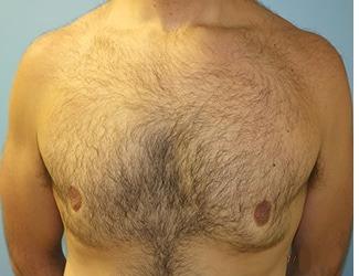 Gynecomastia Before & After Patient #8435