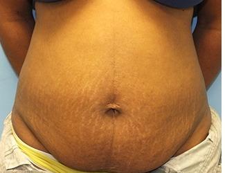 Tummy Tuck Before & After Patient #8195