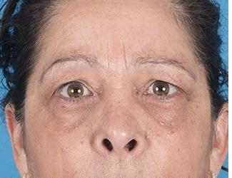 Browlift Before & After Patient #8461