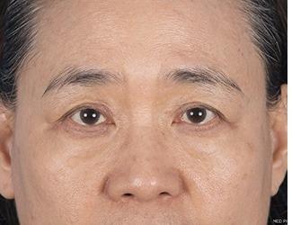 Browlift Before & After Patient #8460