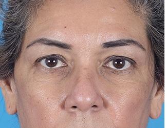 Browlift Before & After Patient #8459