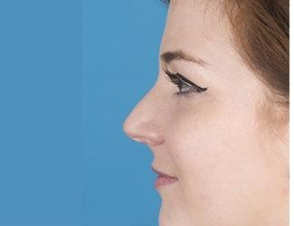 Rhinoplasty Before & After Patient #8809