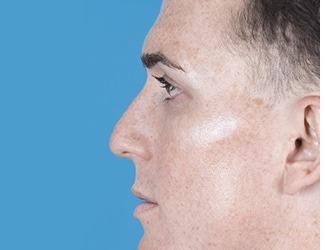 Rhinoplasty Before & After Patient #8808