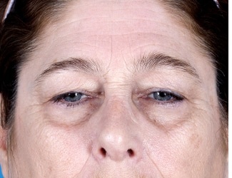 Blepharoplasty Before & After Patient #8533