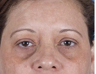 Blepharoplasty Before & After Patient #8481
