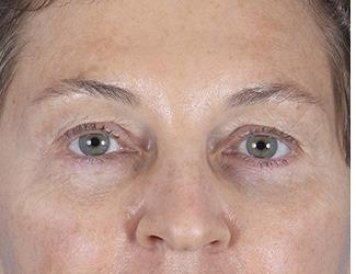Blepharoplasty Before & After Patient #8480