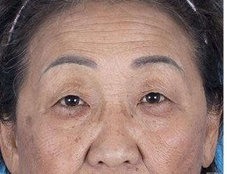 Blepharoplasty Before & After Patient #8478