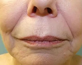 Lip Lift Before & After Patient #8800