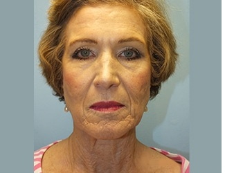 Facial Fat Grafting Before & After Patient #8745