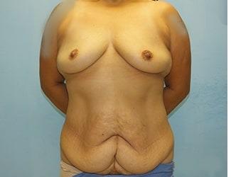 Mommy Makeover Before & After Patient #8019