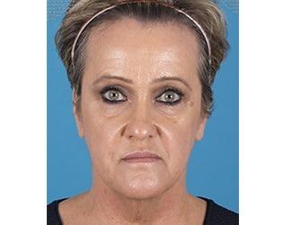 Facial Fat Grafting Before & After Patient #8741