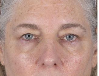 Facial Fat Grafting Before & After Patient #8744