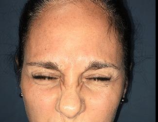 Botox Before & After Patient #8822