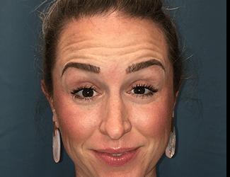 Botox Before & After Patient #8821