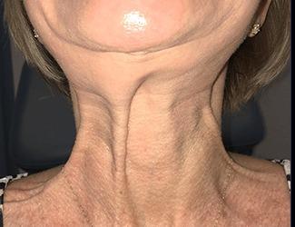 Botox Before & After Patient #8820