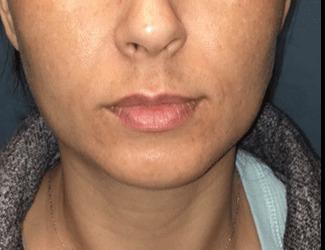 Jeuvederm Before & After Patient #8824