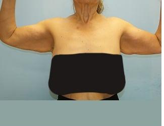 Arm Lift Before & After Patient #4690