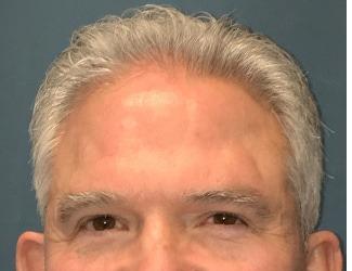 NeoGraft Before & After Patient #8826