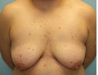 Female to Male Before & After Patient #8442