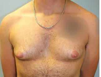 Female to Male Before & After Patient #8440