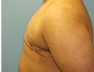 Female to Male Before & After Patient #8437