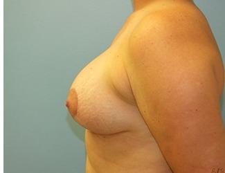 Breast Lift/Mastopexy Before & After Patient #8367