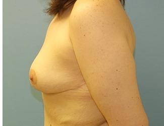 Breast Lift/Mastopexy Before & After Patient #8370