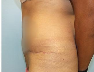 Tummy Tuck Before & After Patient #8199