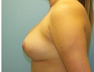 Breast Lift/Mastopexy Before & After Patient #8368