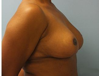 Breast Reduction Before & After Patient #8416