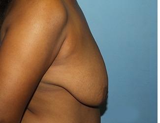 Breast Reduction Before & After Patient #8419