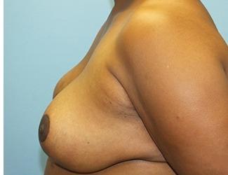 Breast Reduction Before & After Patient #8415