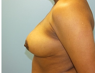 Breast Reduction Before & After Patient #8411