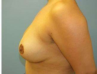 Breast Reduction Before & After Patient #8418