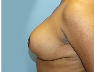 Breast Reduction Before & After Patient #8414