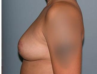 Breast Reduction Before & After Patient #8413